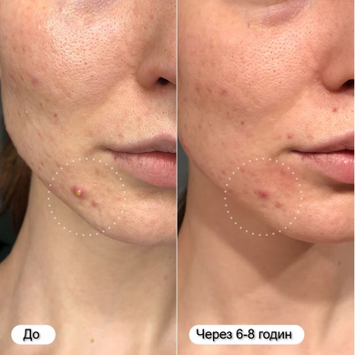 Фото Hero Cosmetics Mighty Patch гідроколоїдні пластирі від прищів Original 36