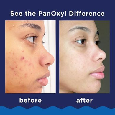 Фото Пінка для вмивання від акне PanOxyl Acne Foaming Wash 10% 156 g Acne